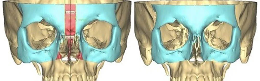 Phẫu thuật “kéo gần” hốc mắt cho con lính đảo ảnh 2