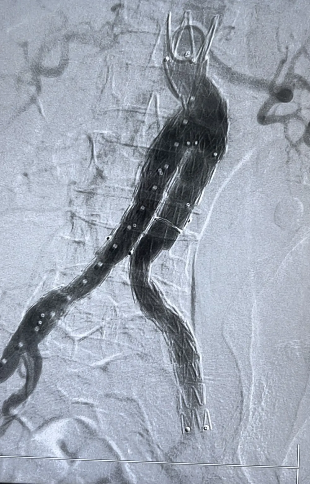 Động mạch chủ của bệnh nhân sau khi can thiệp