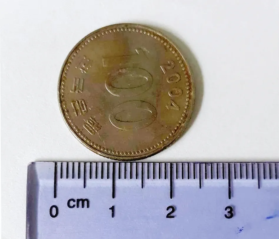 Gắp đồng xu ra khỏi thực quản bé gái 9 tuổi ảnh 1 Gắp đồng xu ra khỏi thực quản bé gái 9 tuổi ảnh 1
