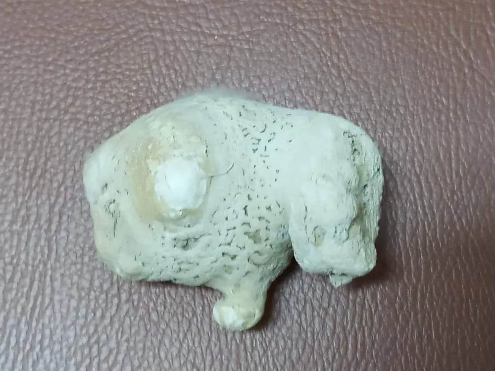 Phẫu thuật lấy sỏi thận “khủng” trên bệnh nhân thận móng ngựa ảnh 1