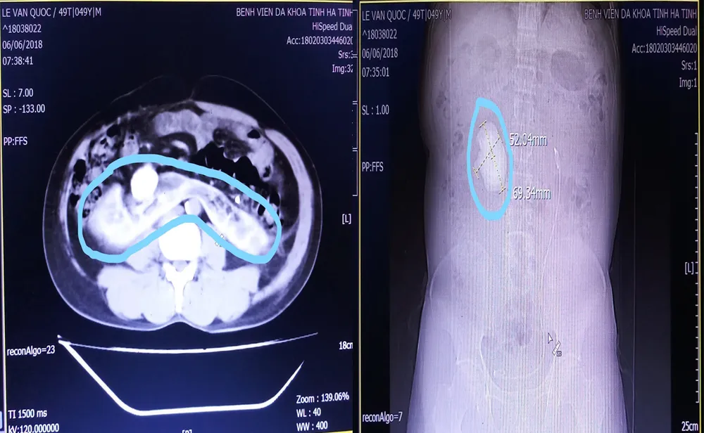 Phẫu thuật lấy sỏi thận “khủng” trên bệnh nhân thận móng ngựa ảnh 2