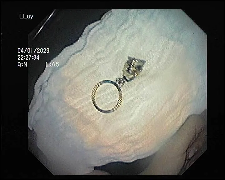 Dị vật đã được lấy ra ngoài