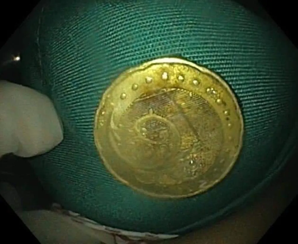 Đồng xu sau khi được gắp ra ngoài Đồng xu sau khi được gắp ra ngoài