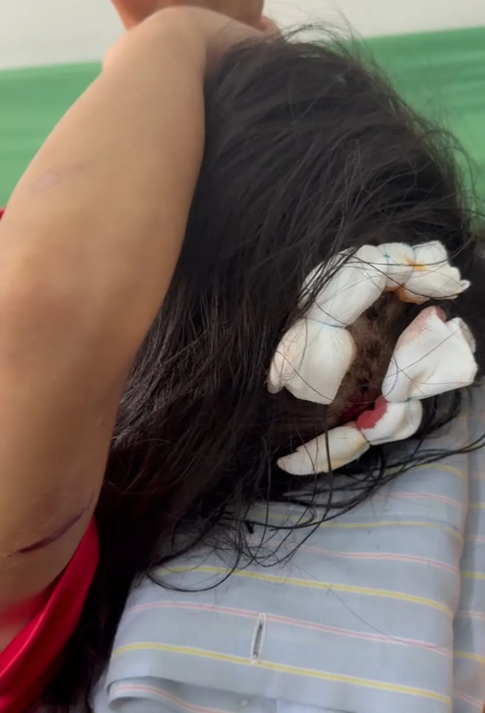 Bé gái với vết thương ở trên cánh tay và đầu. Ảnh cắt từ video 33.jpg