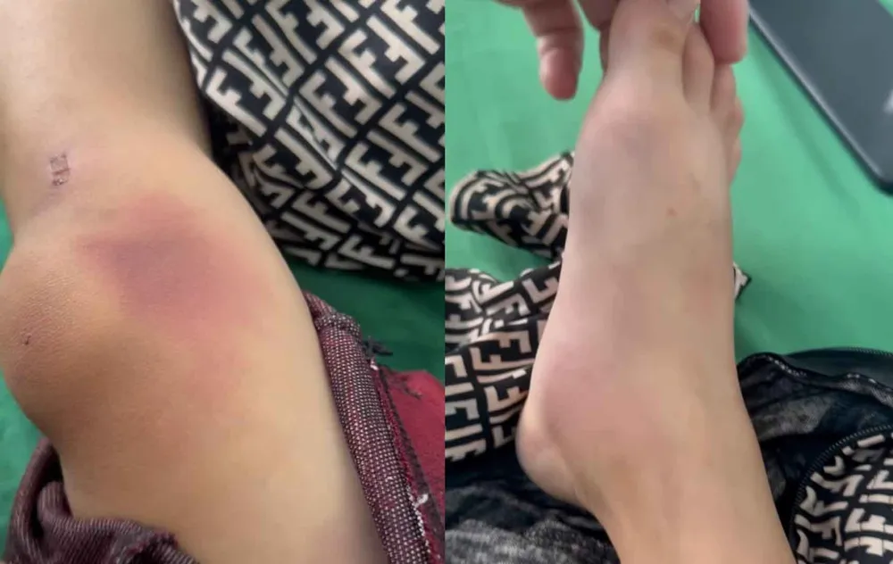 Một bên chân bị sưng vù, chân còn lại với nhiều vết bầm tím. Ảnh cắt từ video a222.jpg