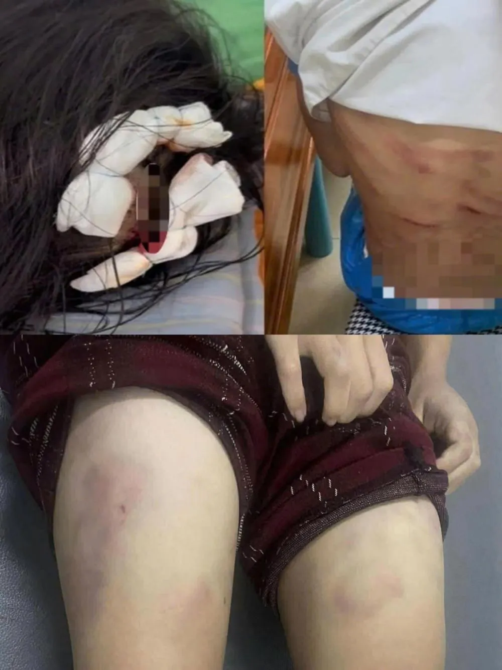 Cháu L. với nhiều vết thương và bầm tím trên người. Ảnh: Công an Hà Tĩnh 68f99af34f241.jpeg