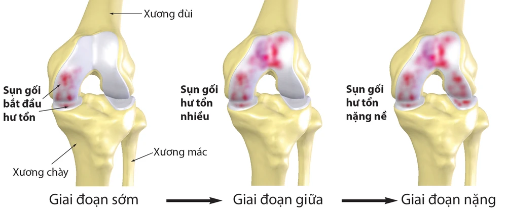 Bệnh nhân thoái hóa xương, khớp ngày càng trẻ hóa