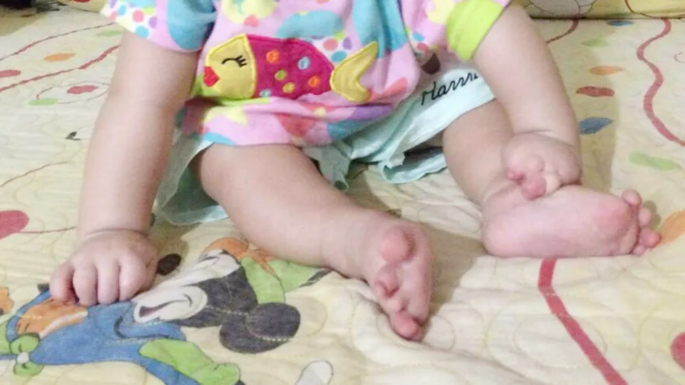 Vòng thắt bẩm sinh khiến bé gái sinh ra bị dính chặt ngón tay, chân ảnh 1