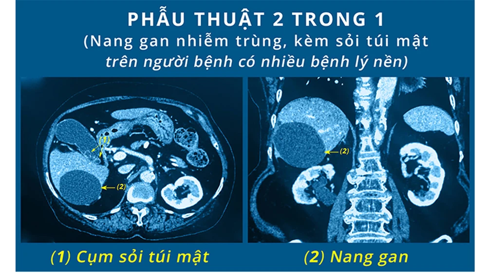 Cứu sống cụ bà 85 tuổi nhiễm trùng nang gan, sỏi túi mật 