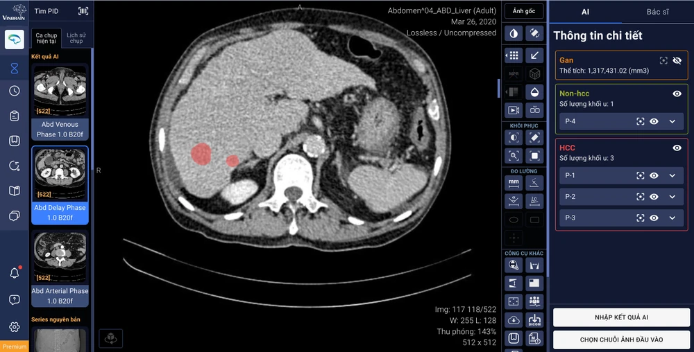DrAid™ hỗ trợ tính năng tự động khoanh vùng và phân loại tổn thương gan ứng dụng trí tuệ nhân tạo, kết nối trực tiếp với phần mềm quản lý hình ảnh của bệnh viện (PACS)