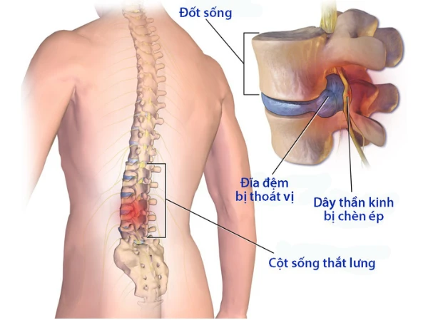 Hiểu để điều trị đúng bệnh lý cột sống