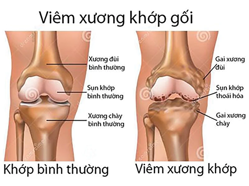 Từ biệt đau đớn do bệnh xương khớp