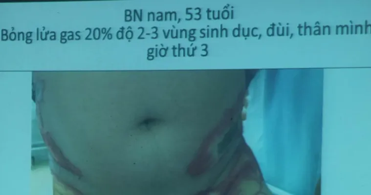 Bệnh nhân bị bỏng cấp độ 3, sâu, tổn thương, hoại tử da, nặng nhất là ở bộ phận sinh dục và hậu môn