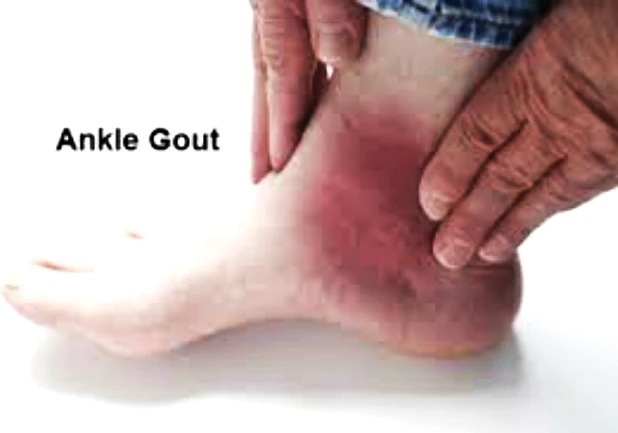 Cách mới chữa trị sỏi thận và bệnh gout