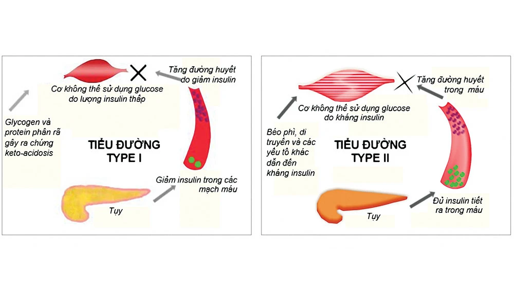 Căn nguyên của bệnh tiểu đường: Mấu chốt nằm ở tuyến tụy