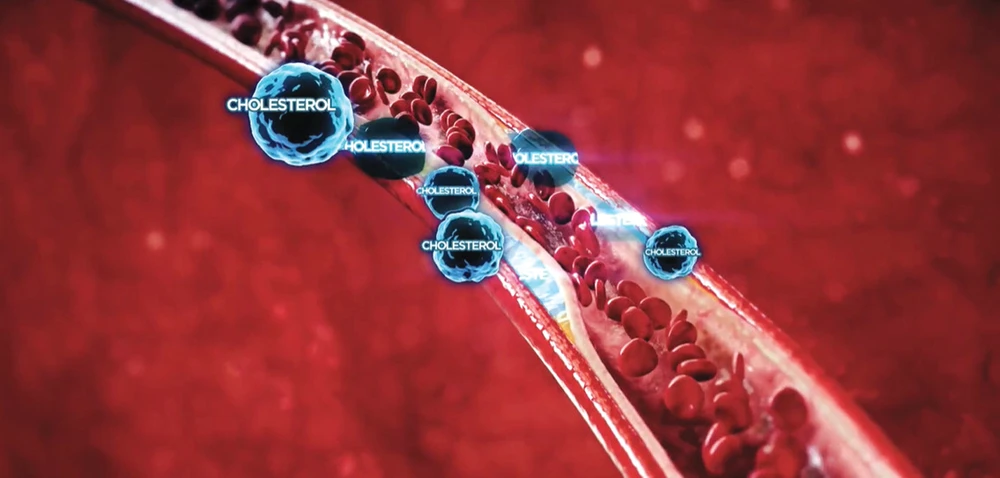 Kiểm soát cholesterol tốt, giảm 27% nguy cơ đột quỵ