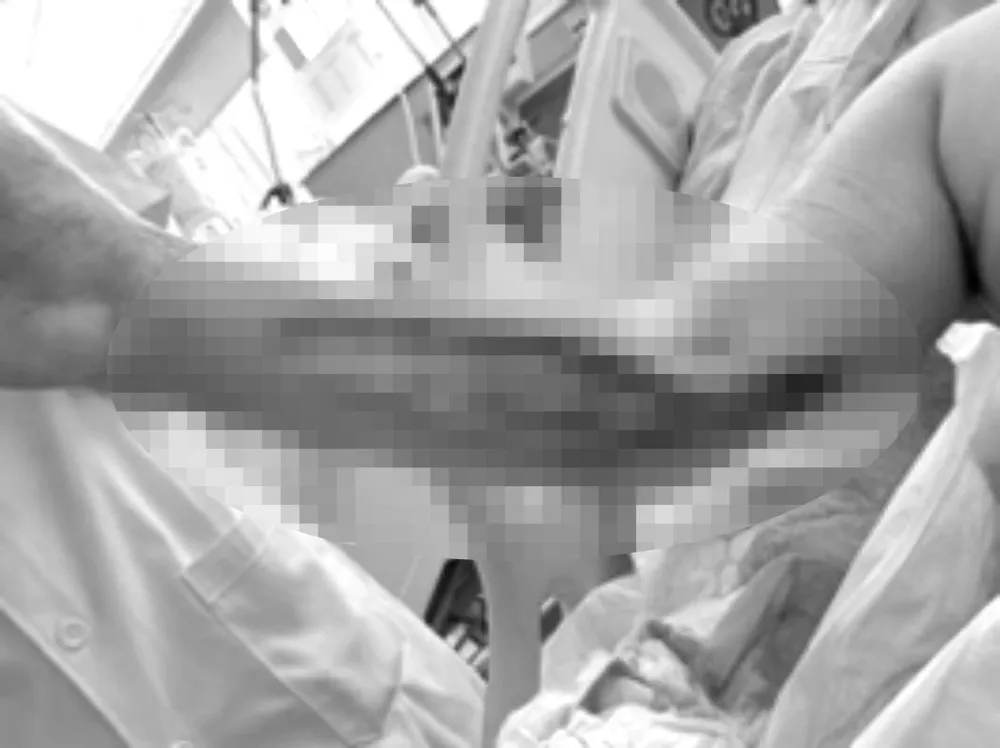 Bệnh nhân được mổ cấp cứu ngay trong đêm để rạch apxe, với hai đường phía trước và phía sau để giải áp và cắt lọc, cấy khuẩn Bệnh nhân được mổ cấp cứu ngay trong đêm để rạch apxe, với hai đường phía trước và phía sau để giải áp và cắt lọc, cấy khuẩn