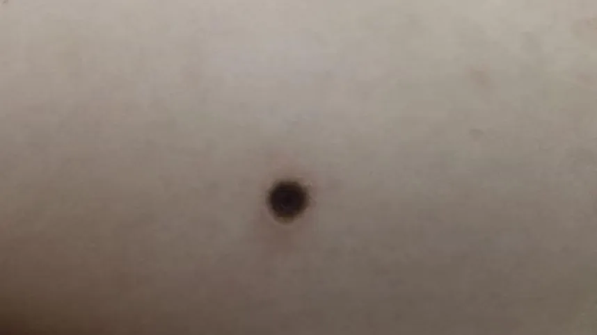 Vết thương trên bệnh nhi sốt mò Vết thương trên bệnh nhi sốt mò