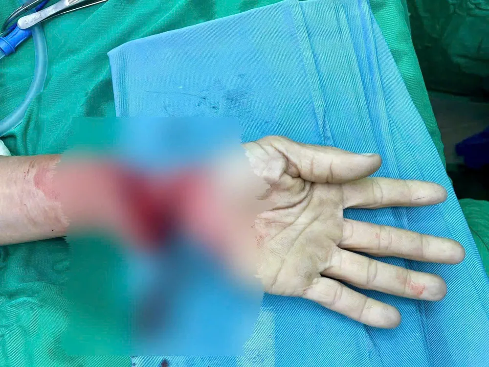 Cổ tay đứt lìa của một bệnh nhân nam. Ảnh: BVĐKKH