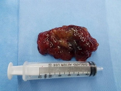 Cứu sống bệnh nhân có khối u lớn trong tim ảnh 1 Cứu sống bệnh nhân có khối u lớn trong tim ảnh 1