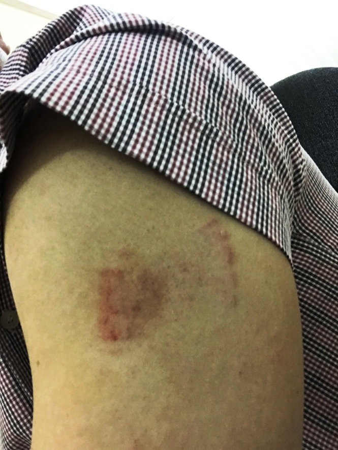 武玉南先生手上的傷口。（圖片來源：愛仁）