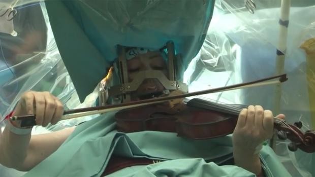 做開顱手術時竟然能拉琴