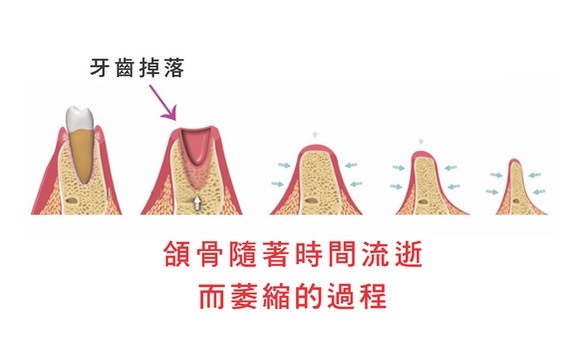 牙齒掉落帶來後果