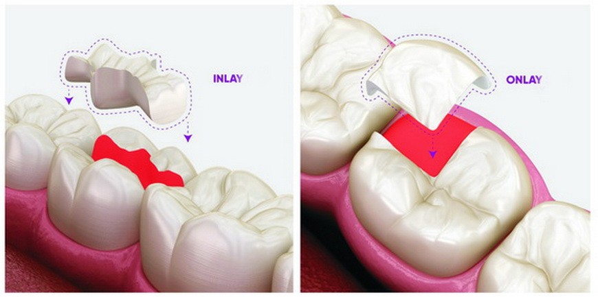 一次可快速修補牙齒崩缺 ảnh 1