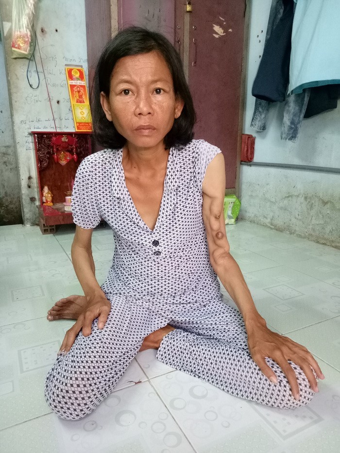 洗腎使陳香的手臂浮腫，全身消瘦。