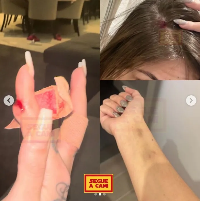 Bằng chứng cáo buộc Antony bạo hành bạn gái cũ