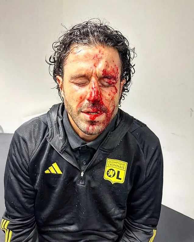 Khuôn mặt bê bết máu của HLV Grosso