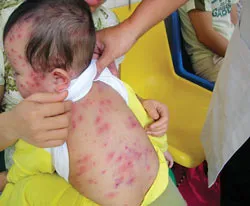 Khu vực phía Nam: Bệnh thủy đậu đang bùng phát