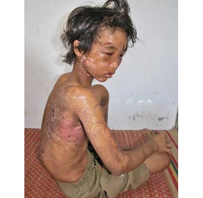 Hoang Anh is being admitted into the hospital with many scars and injuries on his small body. Police will use them as evidence against the cruel couple Hoang Anh is being admitted into the hospital with many scars and injuries on his small body. Police will use them as evidence against the cruel couple