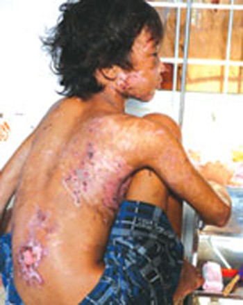 Nguyen Hoang Anh displays wounds caused by a cruel couple who hired him to work for their shrimp farm in Ca Mau Province (Photo: Thanh Nien) Nguyen Hoang Anh displays wounds caused by a cruel couple who hired him to work for their shrimp farm in Ca Mau Province (Photo: Thanh Nien)