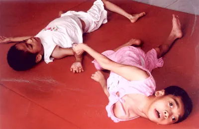 Trẻ bị di chứng chất độc da cam ở Trung tâm Thiên Phước. Trẻ bị di chứng chất độc da cam ở Trung tâm Thiên Phước.