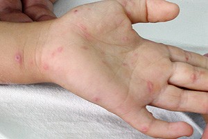 Hand-foot-and mouth babies suffer high fever, blisters on the palms of his hands and the soles of his feet Hand-foot-and mouth babies suffer high fever, blisters on the palms of his hands and the soles of his feet