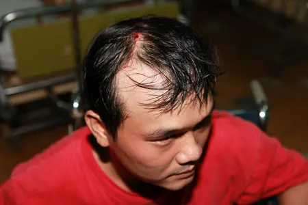 Vết thương trên đầu anh Huỳnh Ngọc Thuận do bảo vệ đánh. Vết thương trên đầu anh Huỳnh Ngọc Thuận do bảo vệ đánh.