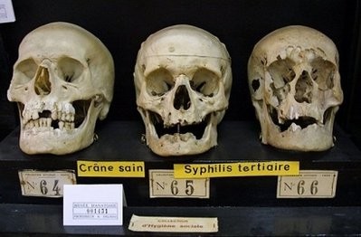File picture shows the skull of a healthy individual (L) and the skulls of two victims of late stage syphilis. The scandal over Guatemalans infected with sex diseases in the 1940s so that US researchers could test remedies has revived painful memories of a similar episode involving African-Americans in the 20th centure. (Photo: AFP) File picture shows the skull of a healthy individual (L) and the skulls of two victims of late stage syphilis. The scandal over Guatemalans infected with sex diseases in the 1940s so that US researchers could test remedies has revived painful memories of a similar episode involving African-Americans in the 20th centure. (Photo: AFP)