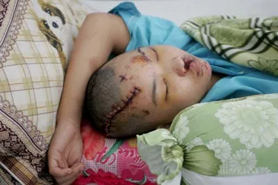 Với một đường cắt như vết chém trên đầu Thu Lạc thế này, thật khó để nói là do tai nạn giao thông. Ành: PHI HẢI