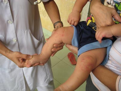 Children contracting the disease will have these blister on hand, foot and mouth Children contracting the disease will have these blister on hand, foot and mouth