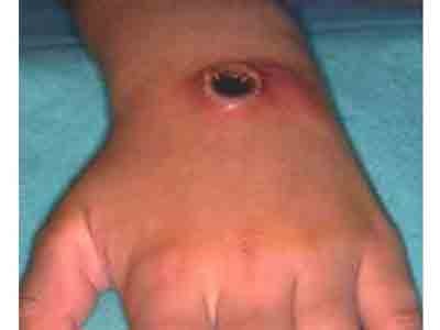 Anthrax can infect through the skin Anthrax can infect through the skin