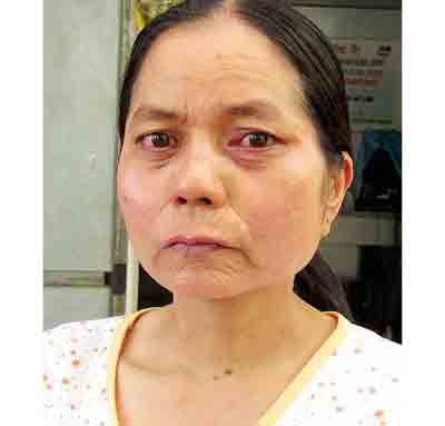27 year old woman turning age overnight in the central province of Quang Nam needs help of medical experts (Photo: SGGP) 27 year old woman turning age overnight in the central province of Quang Nam needs help of medical experts (Photo: SGGP)