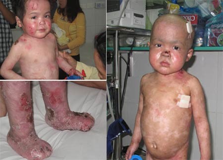 Young Viet Anh with blisters all over his body prior to the bone marrow stem-cell transplant Young Viet Anh with blisters all over his body prior to the bone marrow stem-cell transplant