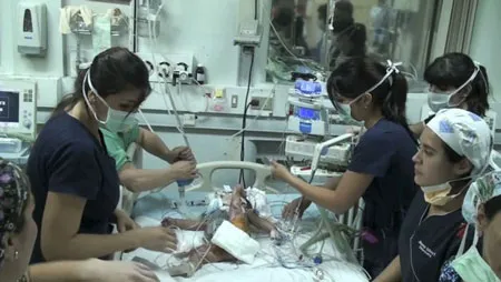Một bé trong cặp sinh đôi tại Chile sau khi đã được phẫu thuật Một bé trong cặp sinh đôi tại Chile sau khi đã được phẫu thuật