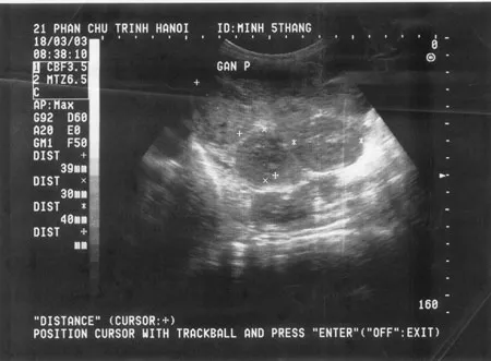 Ảnh siêu âm trước điều trị (18/03/2003) Ảnh siêu âm trước điều trị (18/03/2003)