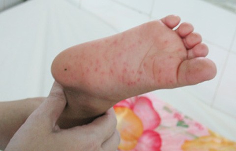 Hand-foot-mouth disease threatens Vietnam again ảnh 1 Hand-foot-mouth disease threatens Vietnam again ảnh 1