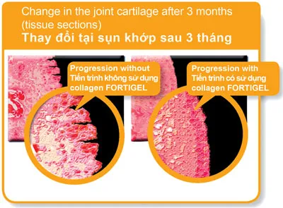 Giúp phục hồi sụn khớp với sản phẩm đến từ Đức