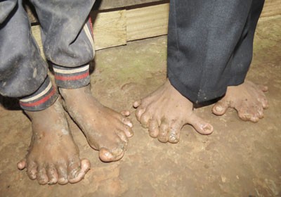 Ho Kec and Ho Cao have extra toes on their feet (Photo: SGGP) Ho Kec and Ho Cao have extra toes on their feet (Photo: SGGP)