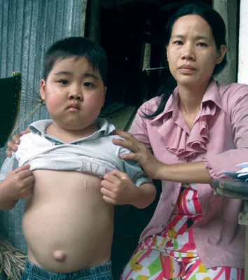Bệnh thận hành hạ bé 5 tuổi