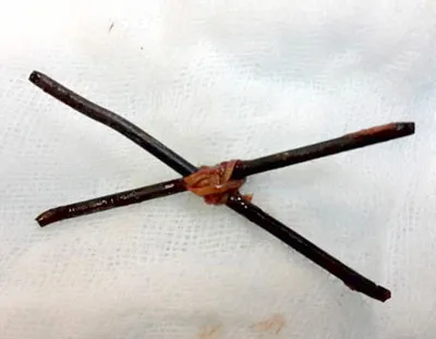 2 cây đinh 5cm nằm trong phổi hơn 1 năm